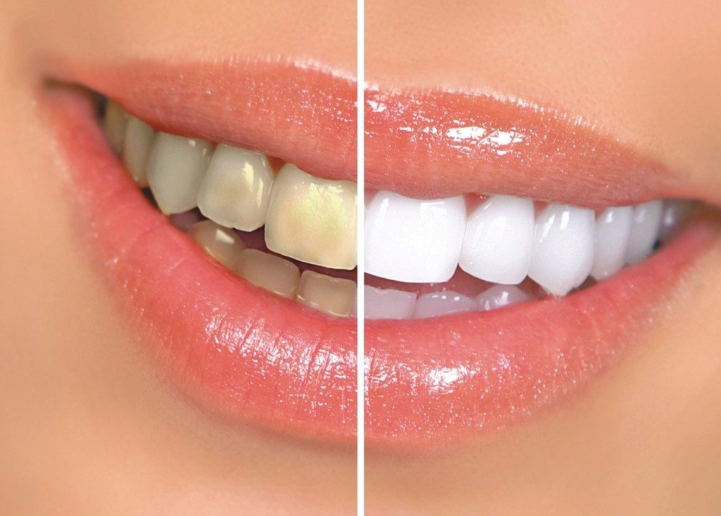 bellevue dentists for teeth whitening